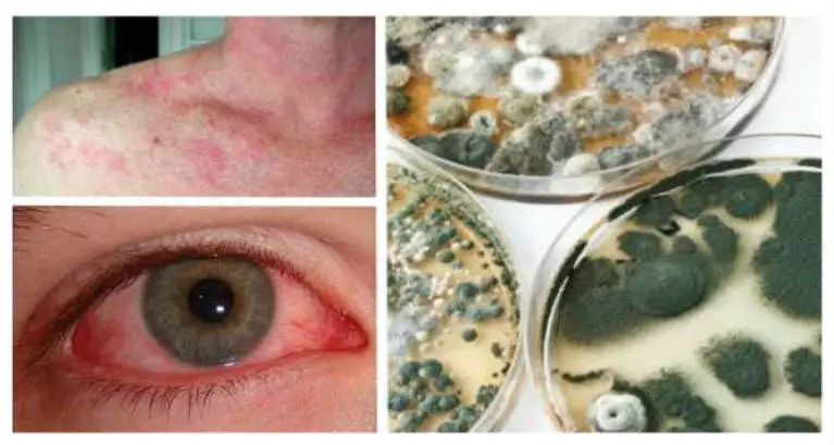14 Early Warning Signs of Mold Toxicity Everyone Should ...