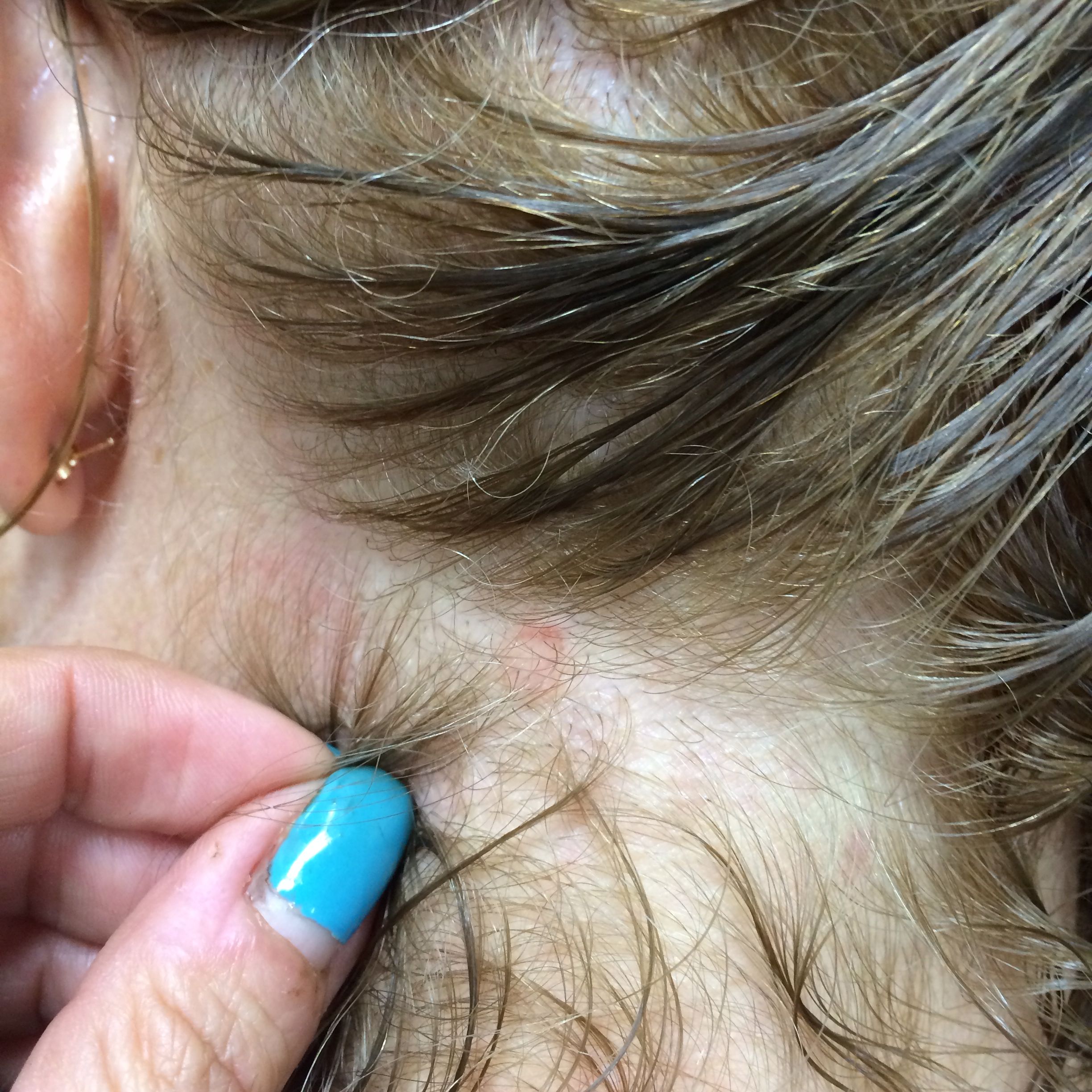 Possible scalp ringworm